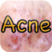 Acne Eraser